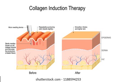 Collagen induction therapy (microneedling) is a surgical for remove wrinkles, scars, stretch, marks, pigmentation. skin needling procedure, repeatedly puncturing the skin with tiny