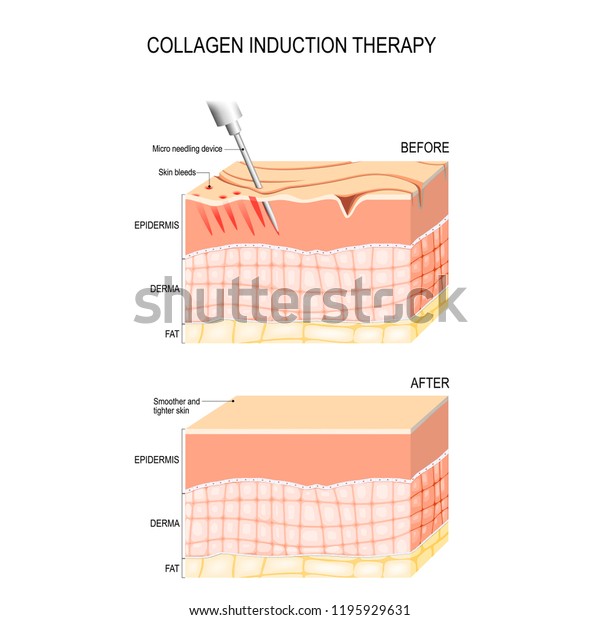 Collagen induction therapy (microneedling) is a\
surgical for remove wrinkles, scars, stretch, marks, pigmentation.\
skin needling procedure, repeatedly puncturing the skin with tiny,\
sterile needles