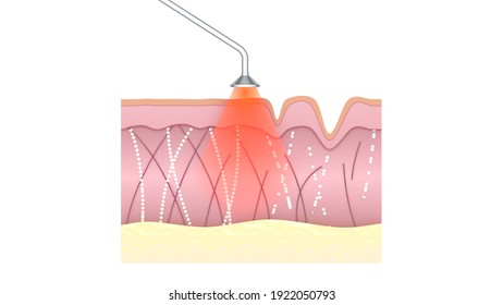 Collagen Stimulation Therapy. Skin Tissue Before And After Laser Treatment. Illustration Showing Skin Rejuvenation And Wrinkle Removal Process. 