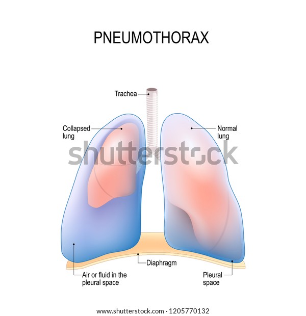 lung pus
