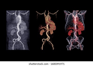  Collection Of CTA Abdominal Aorta 3D Rendering Image Showing Aortic Dissection .