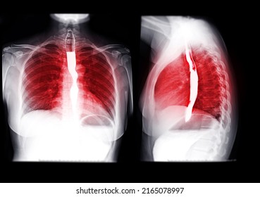 Collection Of Esophagram Or Barium Swallow  Showing Esophagus For Diagnosis GERD Or Gastroesophageal Reflux Disease Or Esophageal Cancer.