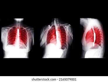 Collection Of Esophagram Or Barium Swallow  Showing Esophagus For Diagnosis GERD Or Gastroesophageal Reflux Disease Or Esophageal Cancer.