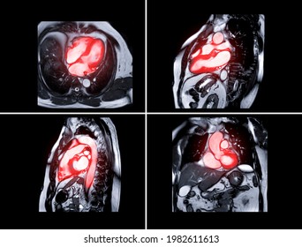 Collection Of MRI Heart Or Cardiac MRI Magnetic Resonance Imaging Of Heart  For Diagnosis Heart Disease.