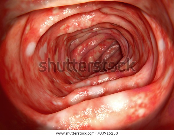 amebic colitis vs ulcerative colitis