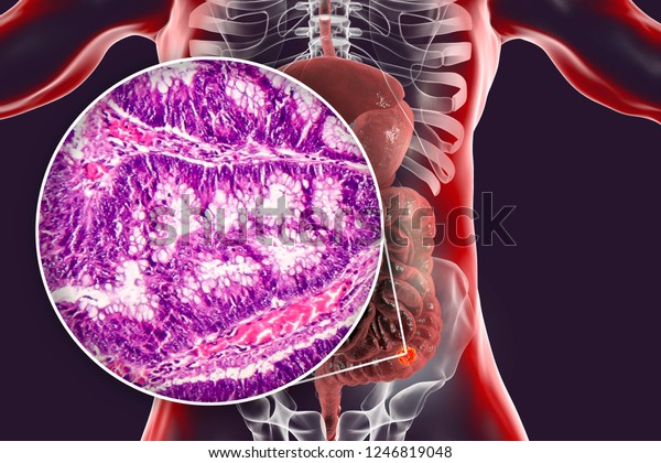 Colon cancer, 3D\
illustration and photo under microscope. Light micrograph showing\
colon\
adenocarcinoma