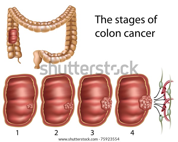 Colon Cancer Stock Illustration 75923554 8361