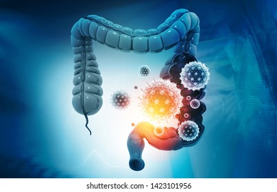Colon cancer, bacterias, viruses in sick unhealthy intestine. 3d illustration	