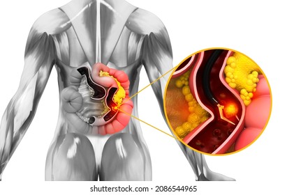 colon cancer. colonoscope in the colon. polyp removal. 3d illustration