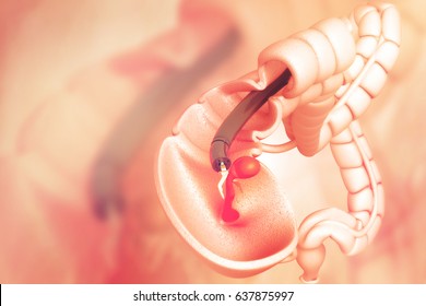 Colon Cancer. Colonoscope In The Colon. Polyp Removal.3d Illustration