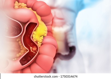 Colon Cancer. Colorectal Surgery. 3d Illustration