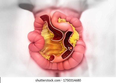 Colon Cancer. Colorectal Surgery. 3d Illustration