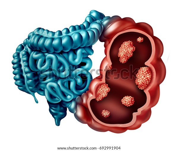 3dイラストとしてのヒト解剖学の内部に顕微鏡的な悪性腫瘍を持つ 強制的な視野を持つヒト腸疾患としての結腸がんのコンセプト のイラスト素材