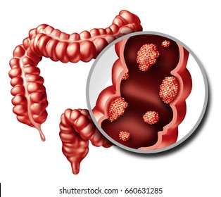 Colon cancer concept as a medical illustration of a large intestine with a malignant tumor growth disease of the digestive system as a 3D illustration.