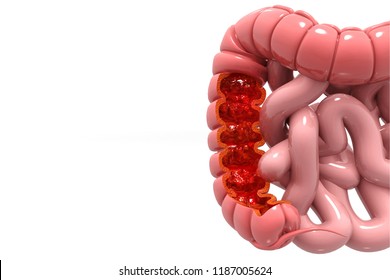 Colon Cancer. Colon Disease Concept. 3d Illustration 