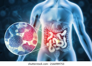 Colon Cancer, Colon Disease Concept, 3d Illustration 