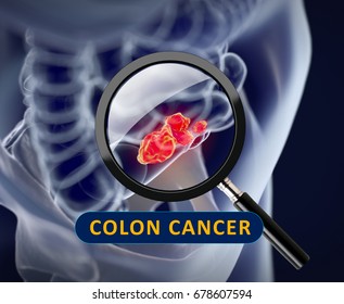 Colon Colorectal Cancermedical Anatomical Illustration3d Illustration ...