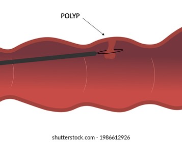 Colon Polyp. Colon Polypectomy Illustration. 