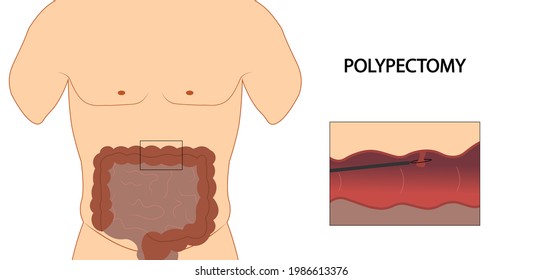 Colon Polyp. Colon Polypectomy Illustration. 