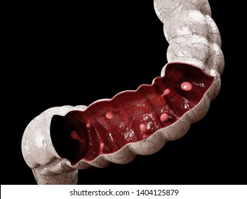 Colon Polyps. 3d Illustration, Polyp In The Intestine.