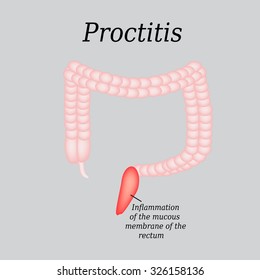 49 Ulcerative Proctitis Images, Stock Photos & Vectors | Shutterstock