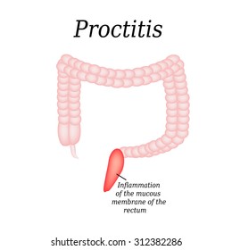 635 Proctitis Images, Stock Photos & Vectors | Shutterstock