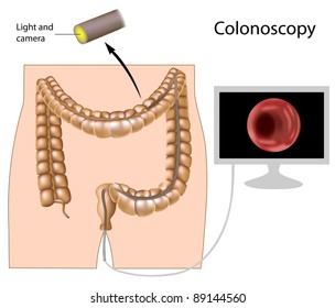 Colonoscopy Procedure Used In Screening Colon Pathology