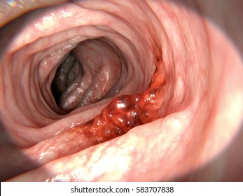 Colorectal Cancer. 3d Rendering.
