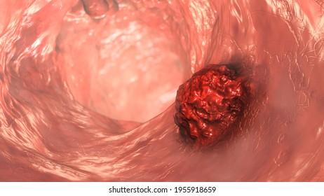 Colorectal Cancer, Intestinal Carcinoma, Bowel Neoplasia, 3D Illustration Showing Malignant Tumor In Intestine