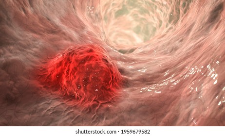 Colorectal Cancer, Intestinal Carcinoma, Bowel Neoplasia, 3D Illustration Showing Malignant Tumor In Intestine