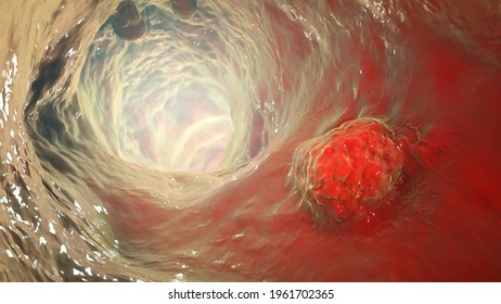 Colorectal Cancer, Intestinal Carcinoma, Bowel Neoplasia, 3D Illustration Showing Malignant Tumor In Intestine