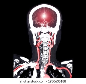 Colorful Of CT Angiography Of The Brain Or CTA Brain  Coronal View . 