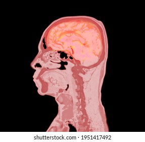 Colorful Of CT Angiography Of The Brain Or CTA Brain  Sagittal View . 