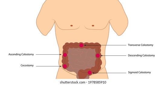 Colostomy anatomy positioning of stoma - Illustration of anatomy colostomy bag positioning