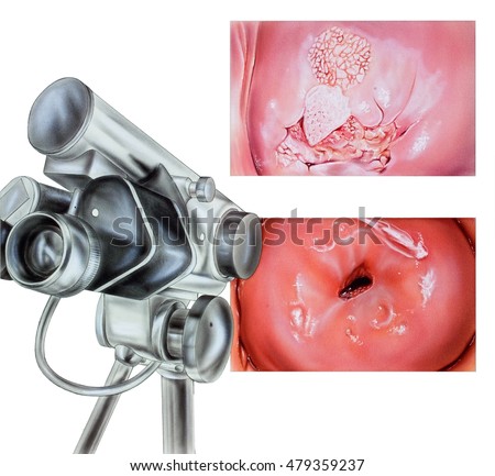 cervix closed except on bottom Cervix closed except on bottom