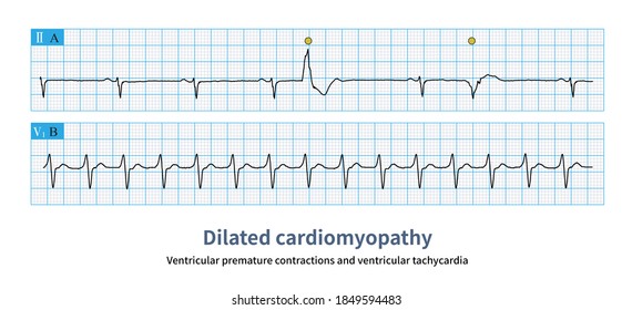 The Common Arrhythmia Of Dilated Cardiomyopathy Also Includes Various Ventricular Arrhythmias.