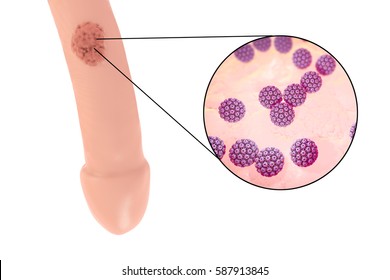 Common locations of genital warts, Human papillomavirus HPV lesions in men, and close-up view of HPV. 3D illustration