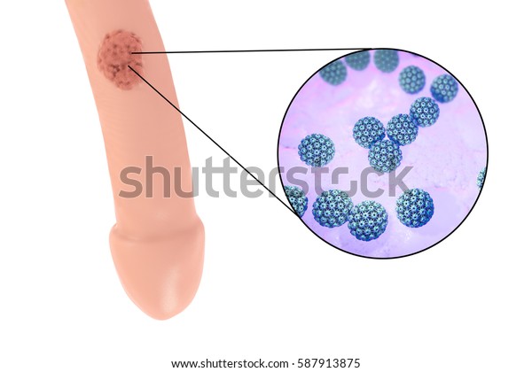 human papillomavirus is genital warts