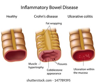 Compare Crohns And Ulcerative Colitis