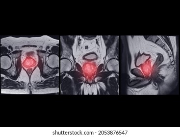 Compare Of MRI Prostate Gland 
 Axial, Coronal And Agittal T2W For Diagnosis Prostate Cancer Cell In Aged Men.