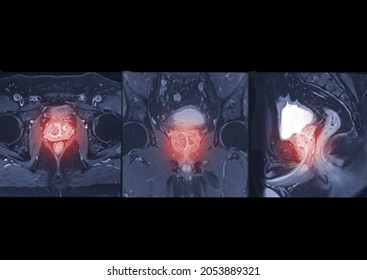 Compare Of MRI Prostate Gland Saxial, Coronal And Agittal T2W For Diagnosis Prostate Cancer Cell In Aged Men.