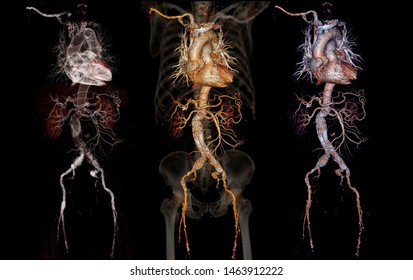Comparison of CTA abdominal aorta 3D rendering image  with stent graft on transparent skeletal .