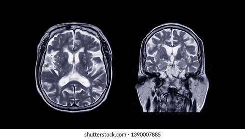 374 Brain cyst Images, Stock Photos & Vectors | Shutterstock