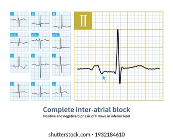 In Complete Inter-atrial Block, The Left Atrium Was Activated Retrogradely By Coronary Sinus Or Right Atrial Septum, And The P Wave In Inferior Lead Was Positive And Negative.