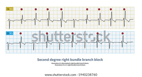 Complete Right Bundle Branch Block Appears Stock Illustration ...