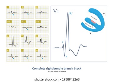 899 Qrs Wave Images, Stock Photos & Vectors | Shutterstock