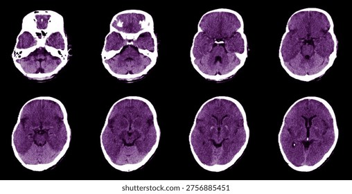 Computed tomographic scan showing hyperdense cerebellum relative to the cerebral hemispheres. White cerebellum sign,white cerebellum sign is a pointer toward severe hypoxic ischemic brain injury