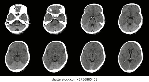 Computed tomographic scan showing hyperdense cerebellum relative to the cerebral hemispheres. White cerebellum sign,white cerebellum sign is a pointer toward severe hypoxic ischemic brain injury