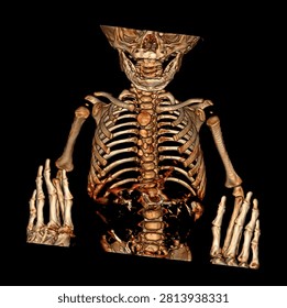 Computed tomography (CT) of the pediatric thorax demonstrates a soft tissue mass adjacent to the heart with multiplanar and volume-rendered reconstruction. CT imaging enables detailed assessment of lesion morphology, anatomical relationships with the heart and mediastinal structures, and provides valuable information for differential diagnosis, surgical planning, and multidisciplinary clinical evaluation