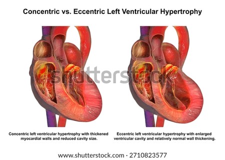 Concentric vs eccentric left ventricular hypertrophy, 3D illustration showing thickened symmetric LV wall in pressure overload compared with dilated LV chamber and thinner wall in volume overload, highlighting clinical implications.